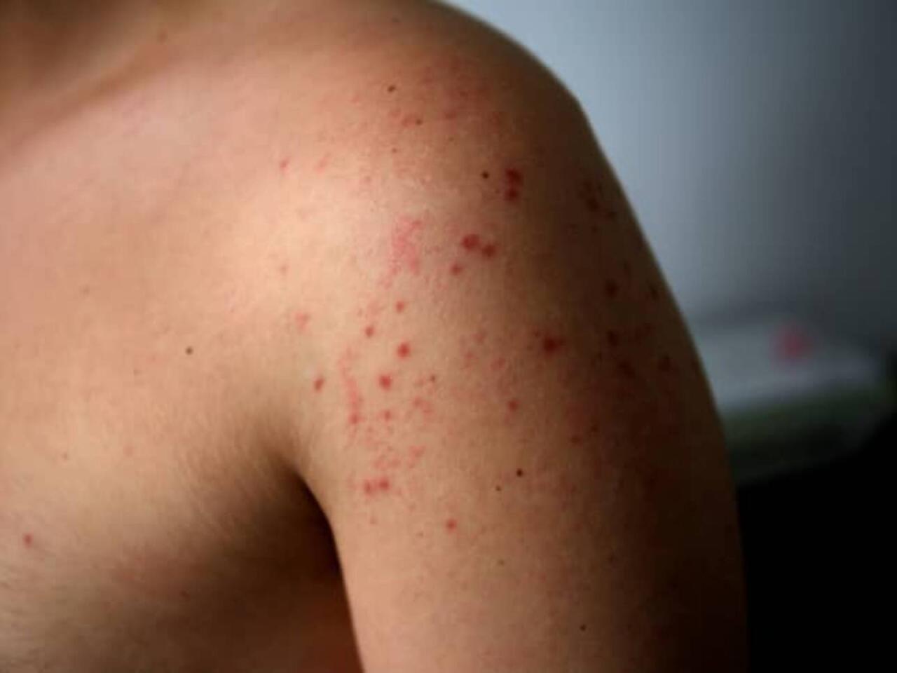 Bu virus dəmir d&ouml;vr&uuml;ndən bəri var imiş