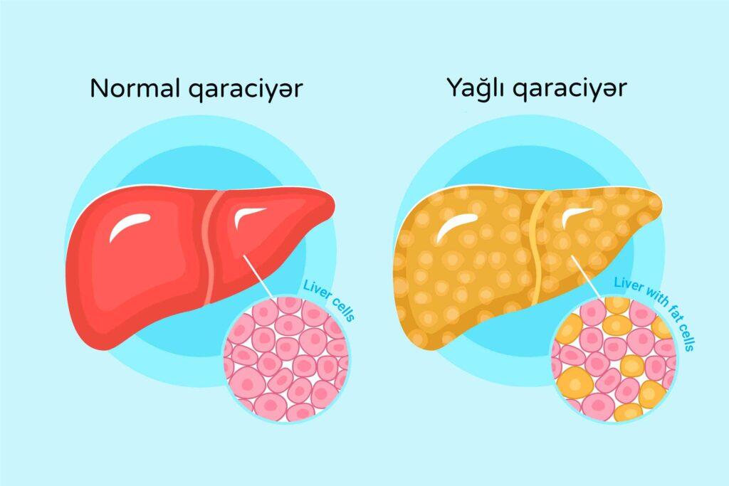 Yağlı qaraciyər xəstəliyinin qarşısını almaq mümkündür – 5 əsas qayda