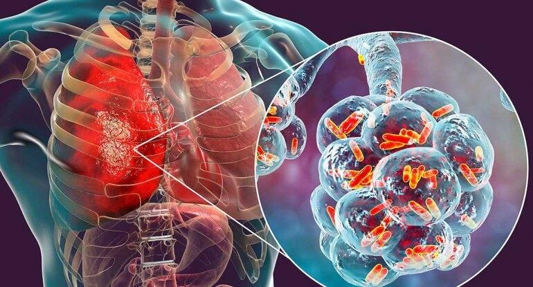 Hovuz və kondisionerlər vasitəsi ilə dəhşətli virus yayılır  50 yaşdan yuxarı...