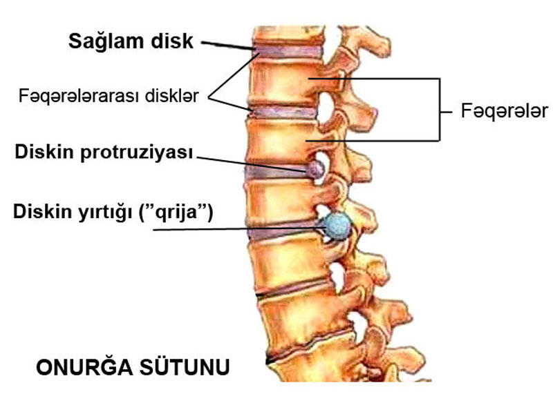 Osteoxondroz nədir?