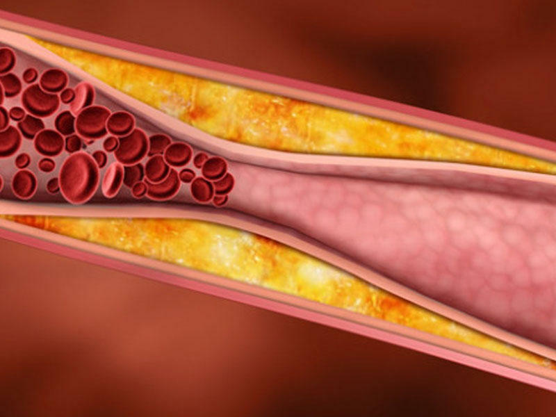 Xolesterinin problemsiz azaldılması