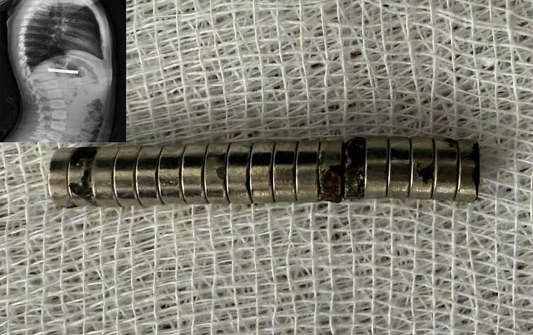 3 yaşlı uşağın boğazından 19 maqnit çıxarıldı  FOTO