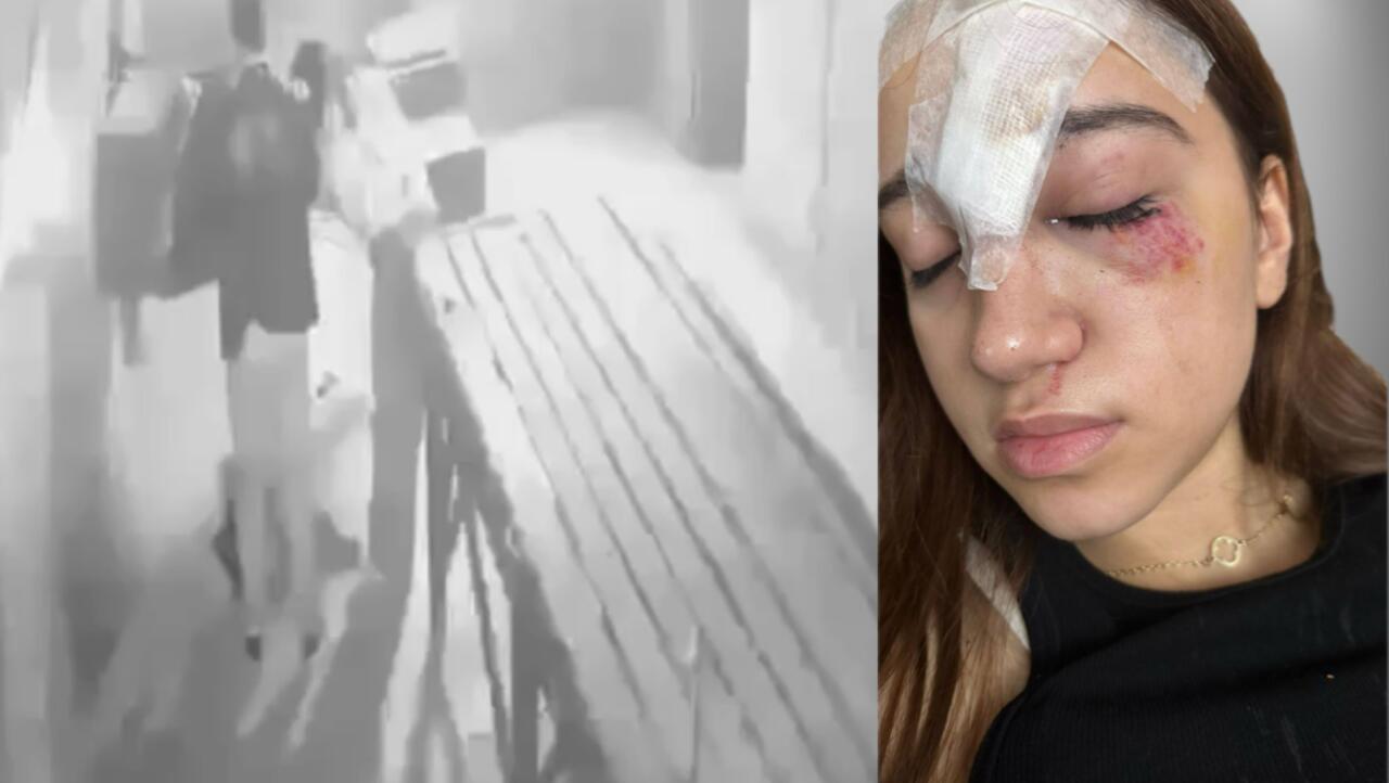 Qorxu evinə getdi  Alnına 11 tikiş qoyuldu