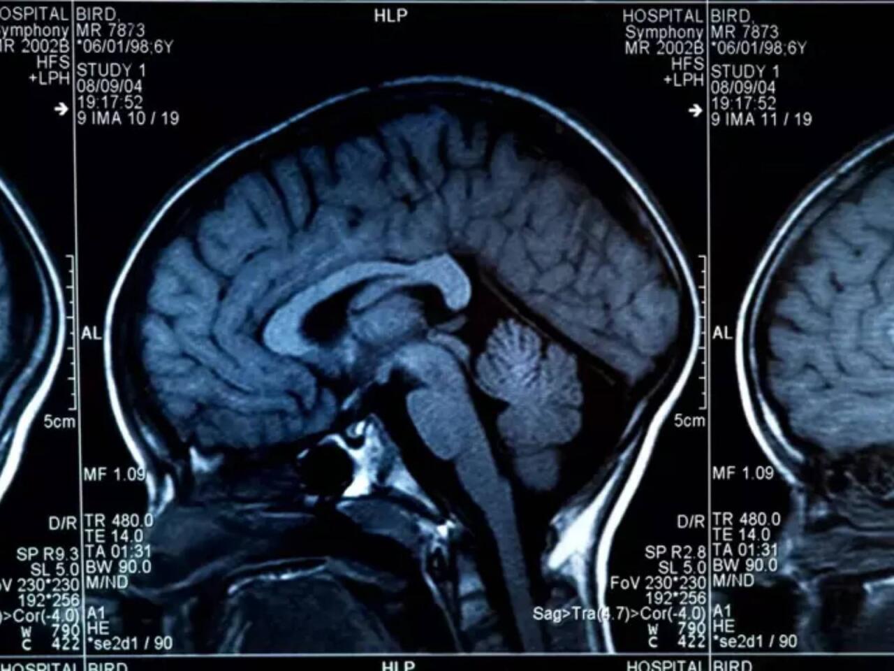 Beyni məhv edən qidalar açıqlandı  Hər gün yeyirik