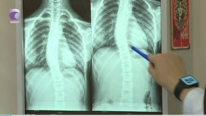 Son zamanlar “812” yaş arası uşaqlarda bel və boyun ağrılarının səbəbi