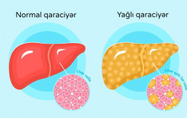 Yağlı qaraciyər xəstəliyinin qarşısını almaq mümkündür – 5 əsas qayda
