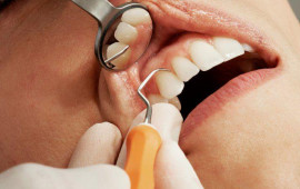 Dişində parodontit olanlar insult keçirə bilər