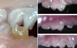 Protezə SON: Yeni dişlərin çıxmasına kömək edən dərman icad edildi