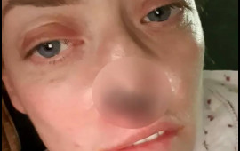 T&uuml;rkiyədə implant etdirən qadının burnu &ccedil;&uuml;r&uuml;məyə başladı  VİDEO