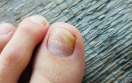 Pambıq və ya fırça ilə dırnağa çəkin  göbələyin kökünü kəsir