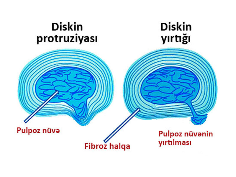 Fəqərəarası diskin protruziyası. Diaqnostika və müalicə