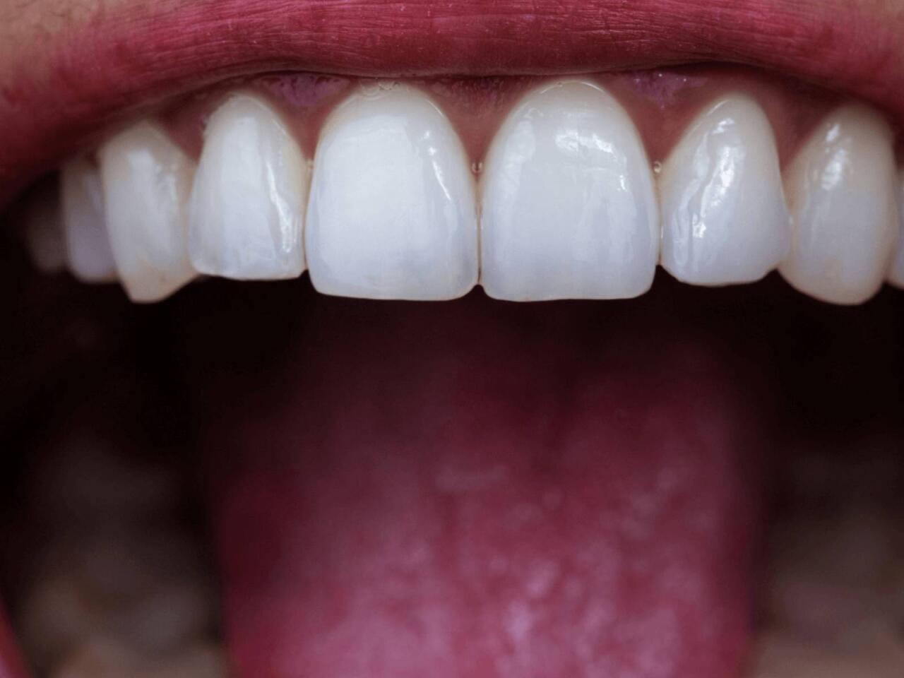 Dişlərin gizli düşməni açıqlandı