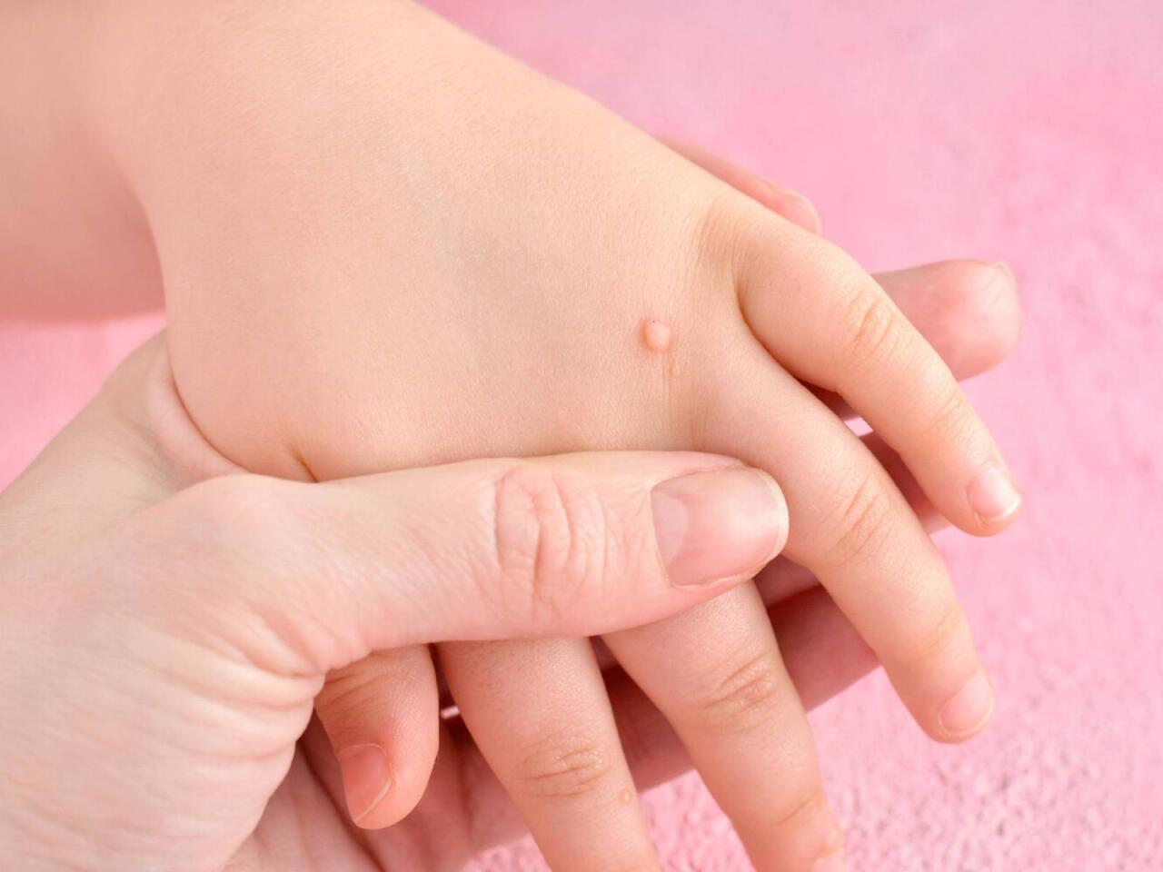 Sarımsaq əzməsini ziyilin üstünə vurun  Yox edəcək