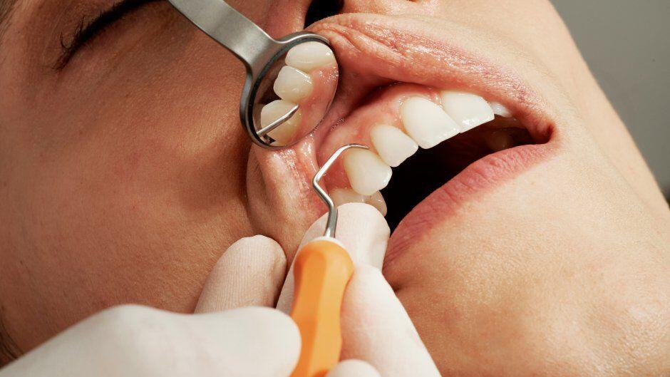 Dişində parodontit olanlar insult keçirə bilər
