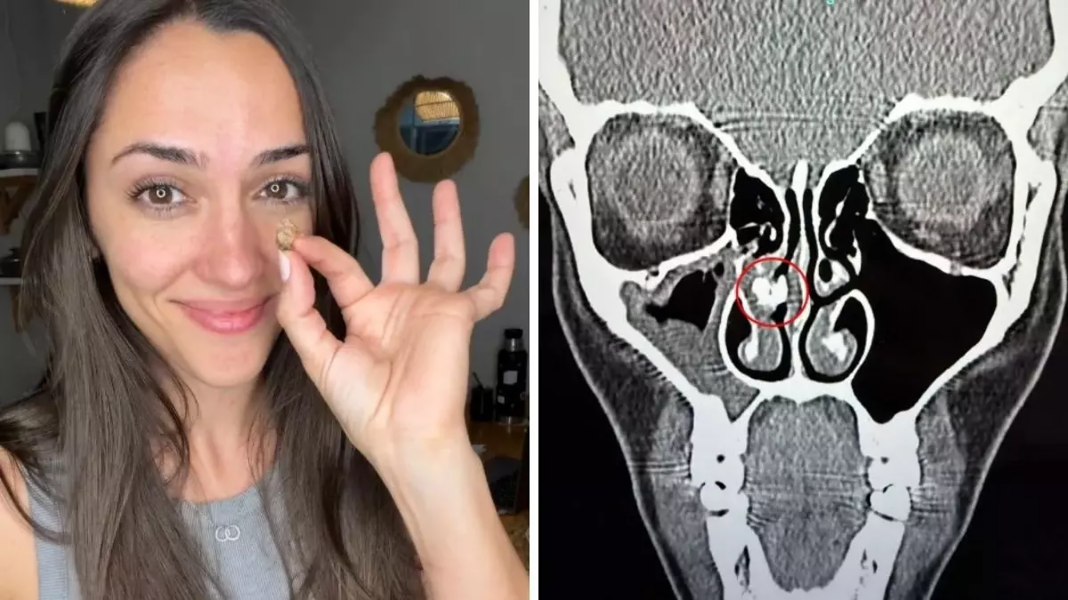 Qadının burnundan görün nə çıxdı  35 ildir belə yaşayıbmış...