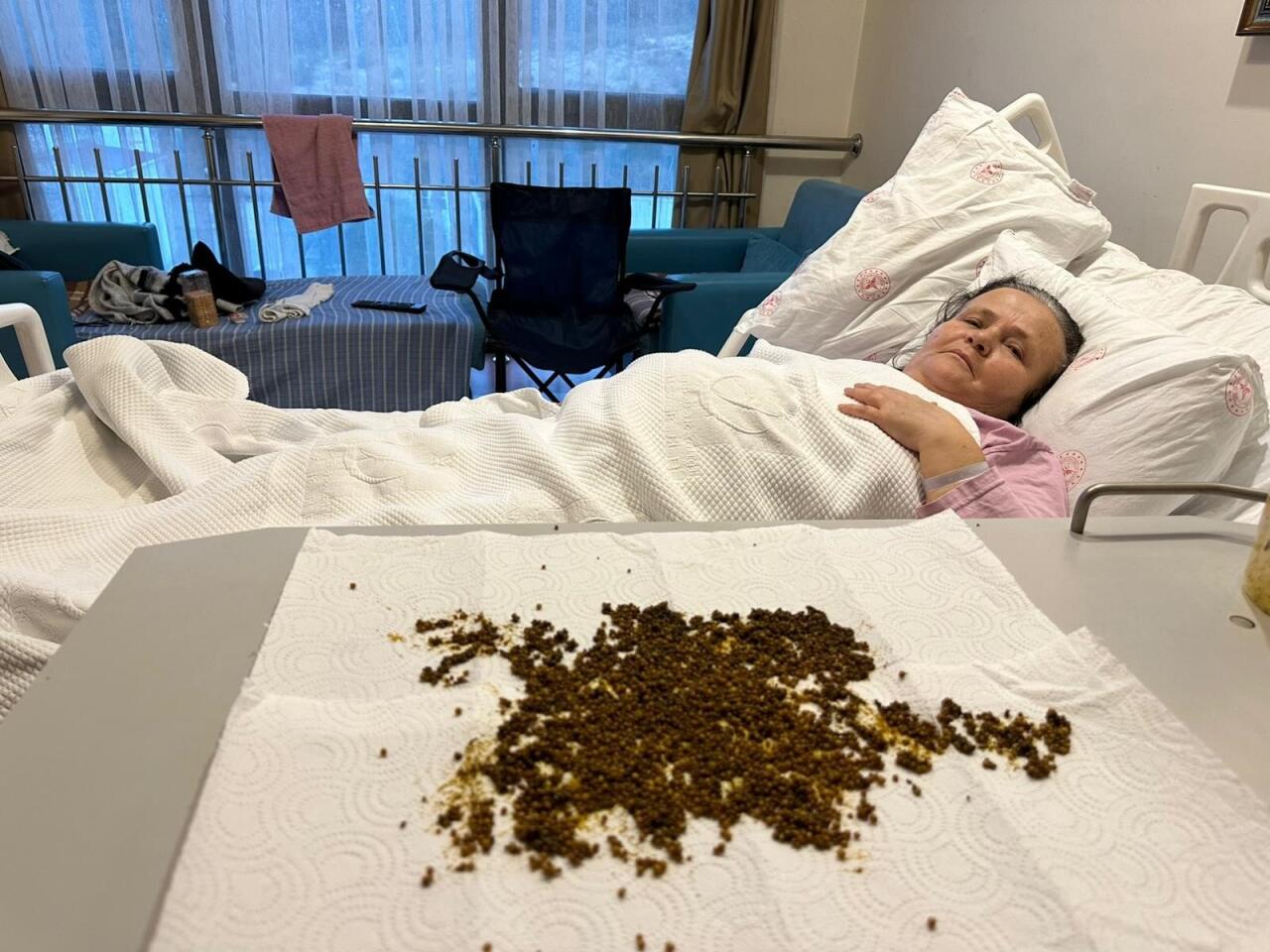 Qarın ağrısından şikayət etdi, ödündən 20 mindən çox daş çıxdı 