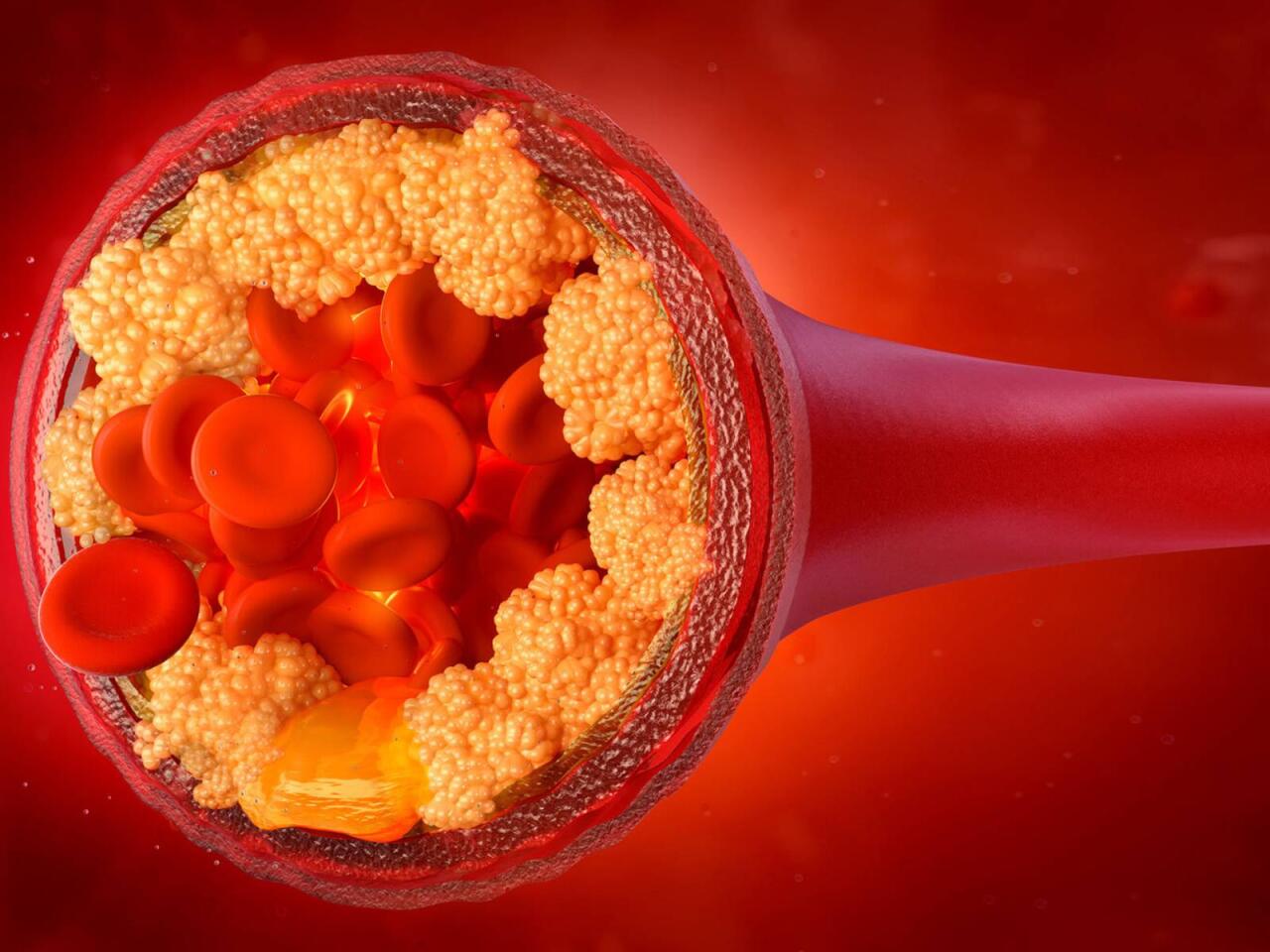 Ailənizdə infarkt olan varsa...  Araşdırmanın qorxunc nəticələri üzə çıxdı