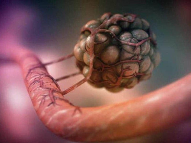 Xər&ccedil;əng m&uuml;alicəsində yeni d&ouml;vr: Kemoterapiyasız tam sağalma