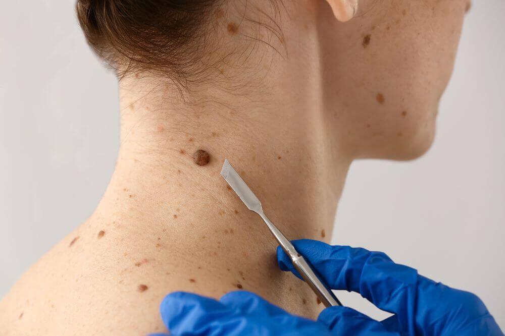 Dəridəki xallar nə vaxt təhl&uuml;kəlidir?  Onkoloqdan a&ccedil;ıqlama