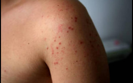 Bu virus dəmir d&ouml;vr&uuml;ndən bəri var imiş