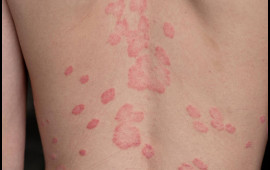 Beldəki səpkilərin yaranma səbəbi a&ccedil;ıqlandı