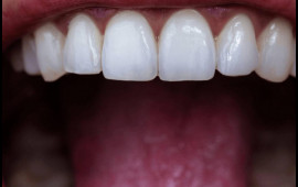 Dişlərin gizli düşməni açıqlandı