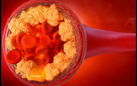 Ailənizdə infarkt olan varsa...  Araşdırmanın qorxunc nəticələri üzə çıxdı