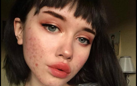 Sızanaqların yaranmasının gözlənilməz səbəbi açıqlandı