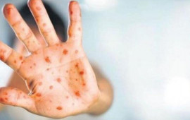 SanktPeterburqda iki nəfərdə meymun&ccedil;i&ccedil;əyi virusu aşkarlanıb